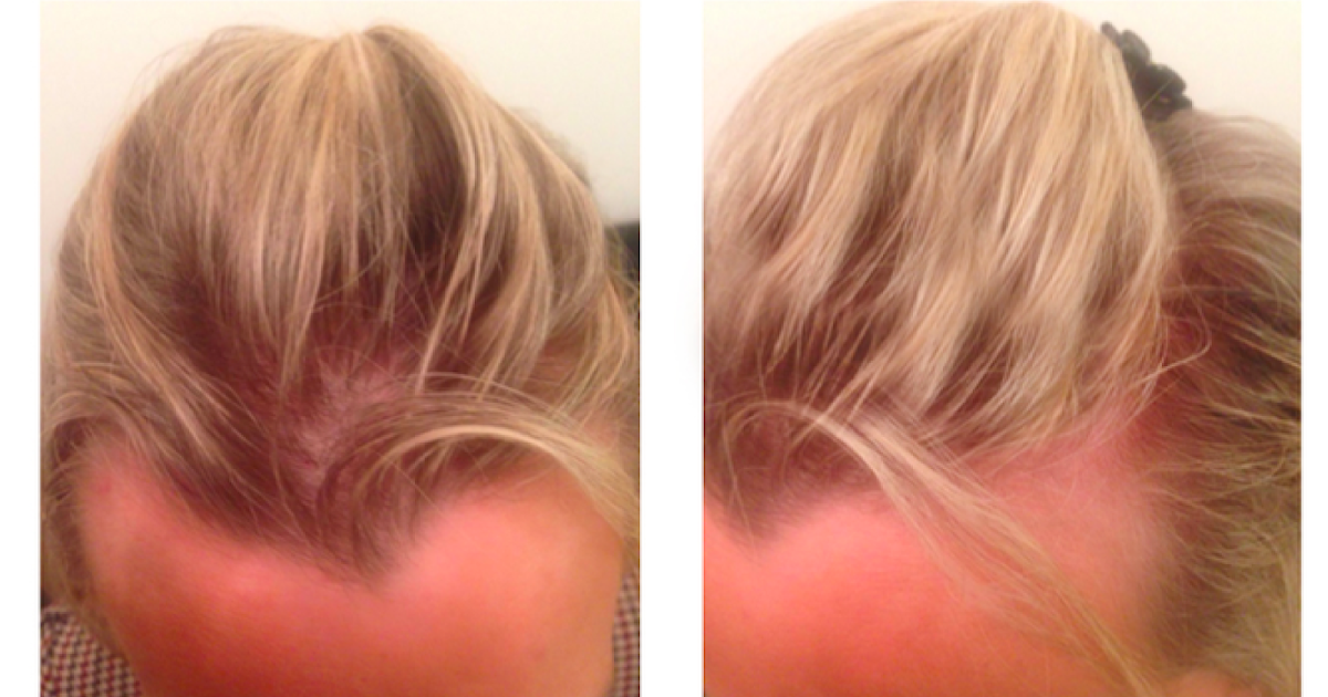 После коронавируса выпадают волосы. Мезотерапия волос до и после. Эффект от мезотерапии волос. Мезотерапия волосистой части головы. Мезотерапия кожи головы до и после.