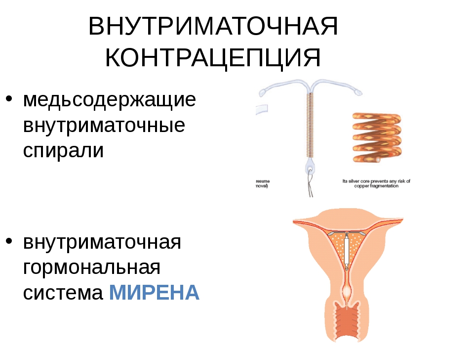 Спираль внематочная фото