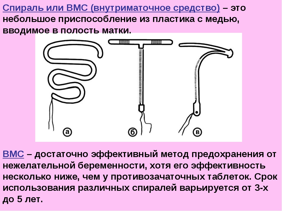 Внутриматочная спираль схема