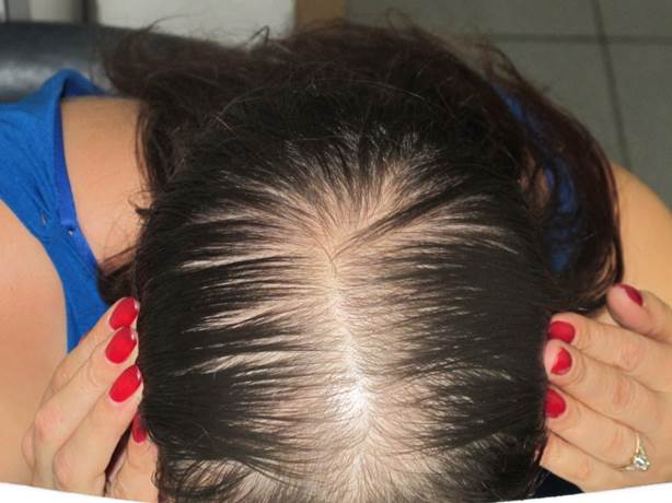Выпадение волос при повышении андрогенов