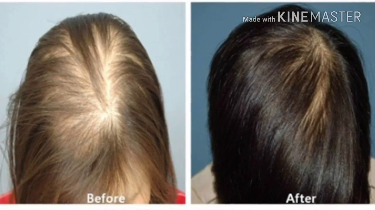 Сильные волосы отзывы. Плазмолифтинг алопеция. Плазмолифтинг для волос алопеция. Мезотерапия для волос. Мезотерапия волос до и после.