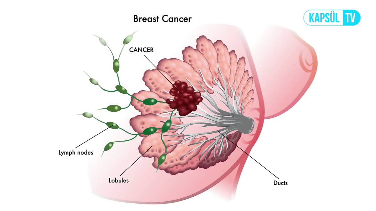 Рак груди в картинках