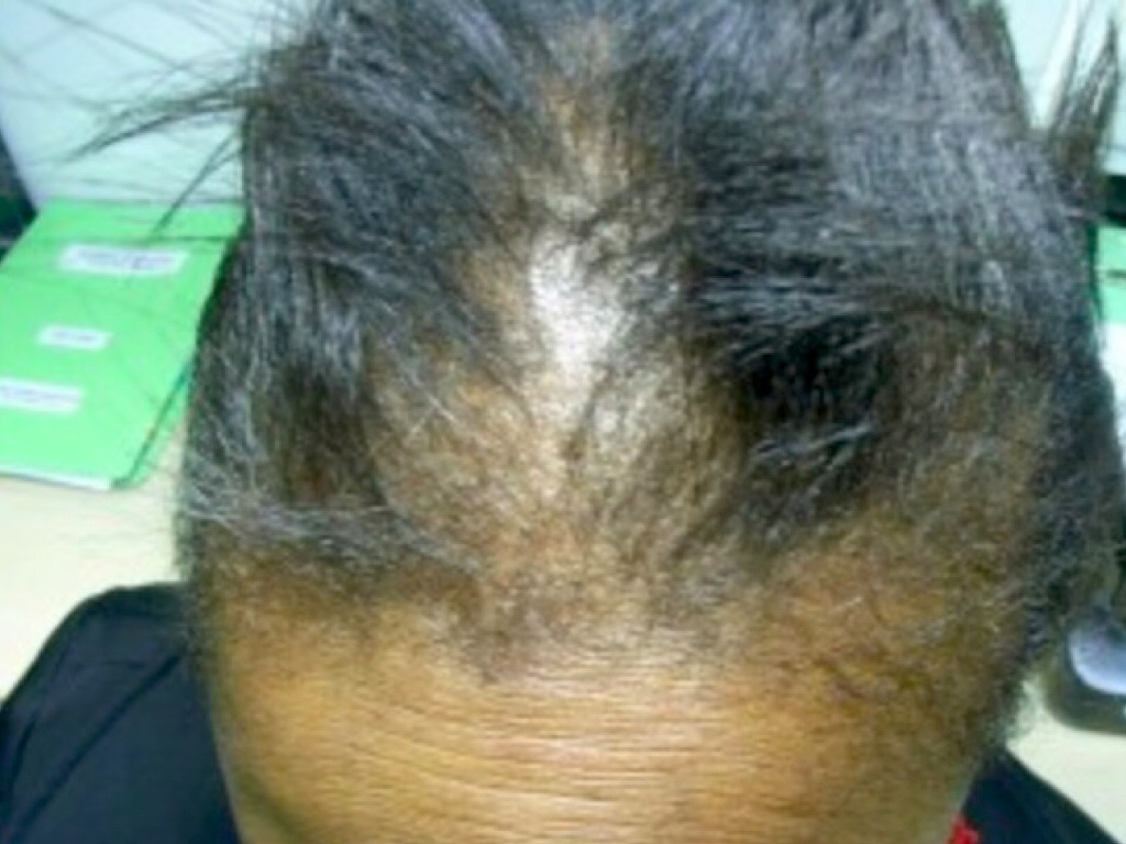 Волосы при анемии