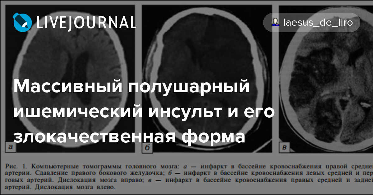 Левосторонний ишемический. Полушарный инфаркт мозга. Полушарный ишемический инсульт. Полушарный инсульт кт.