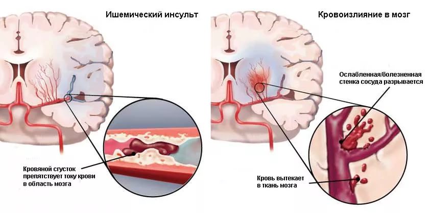 Ишемический инсульт и геморрагический инсульт картинки