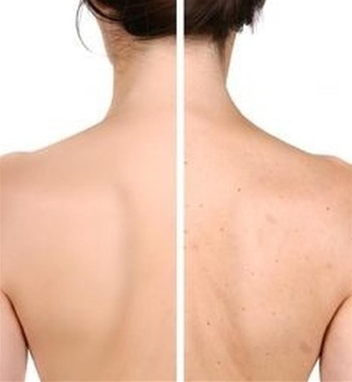 причины прыщей на спине груди у женщин фото 24