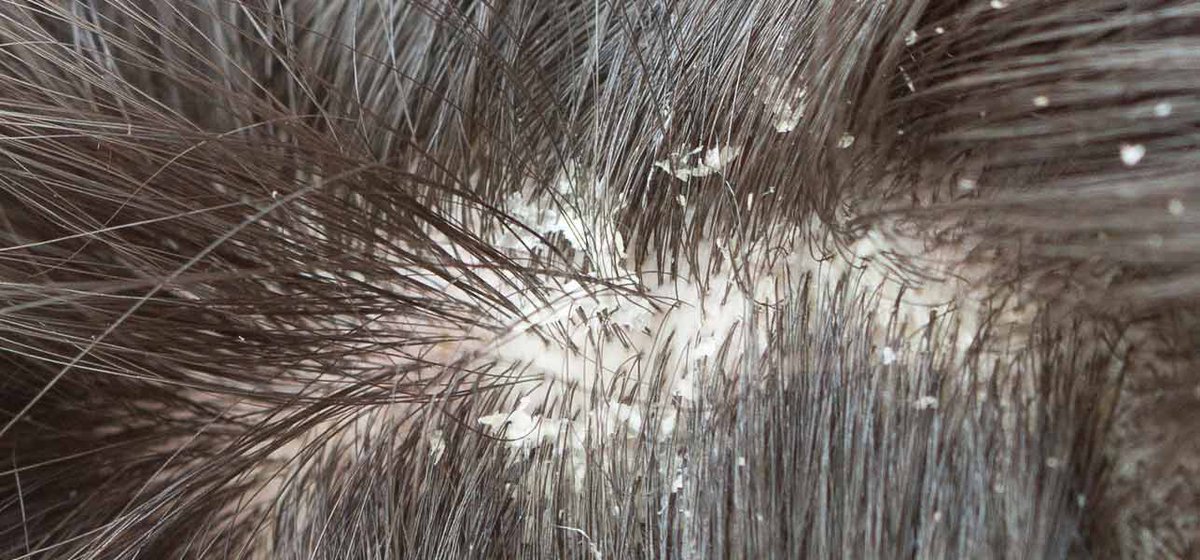 Как вылечить волосы от себореи в домашних условиях