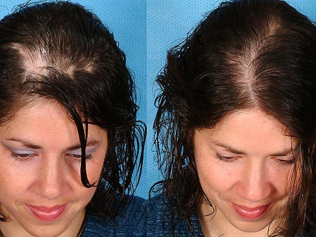 Восстанавливаются ли волосы после антидепрессантов