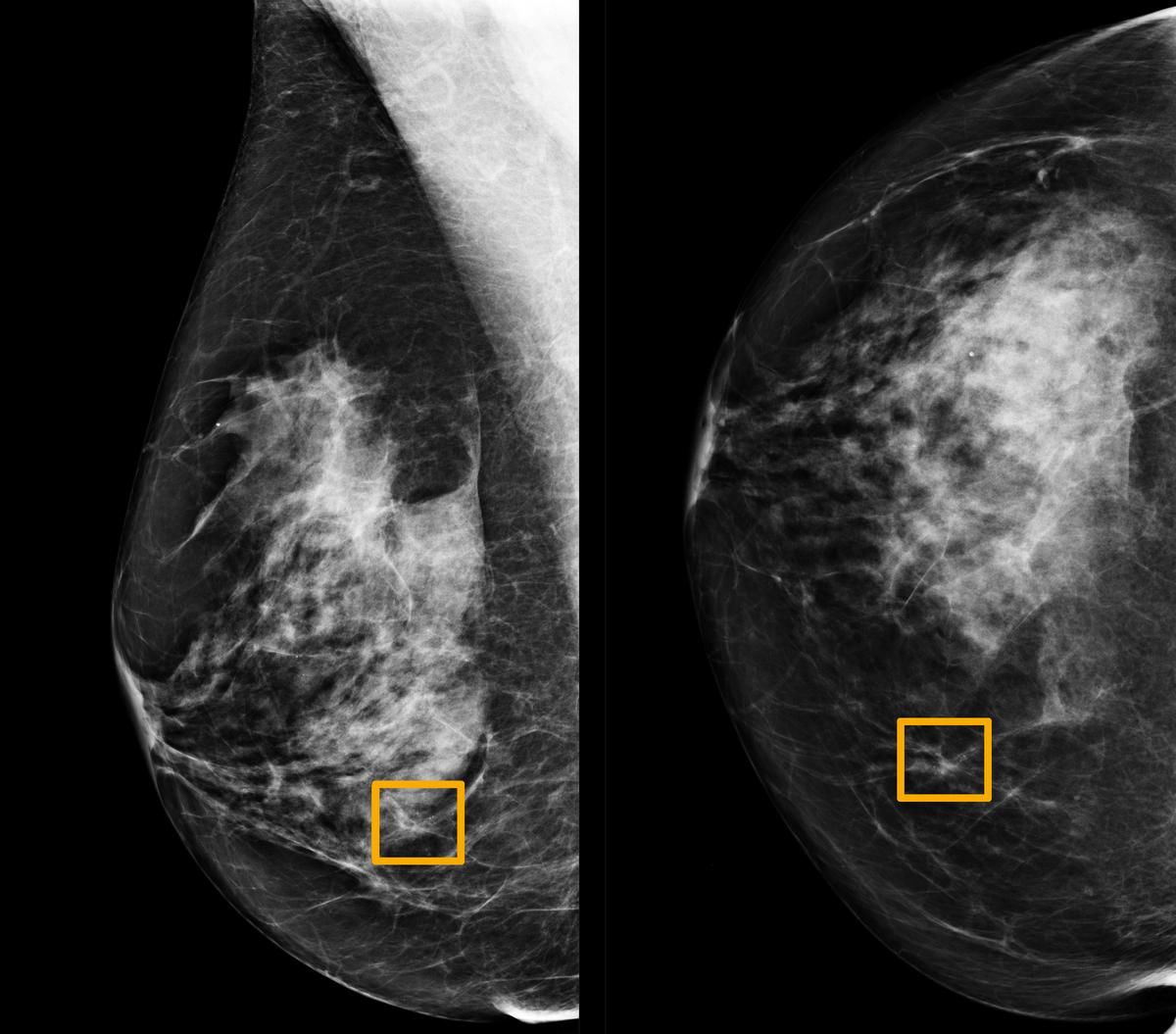 злокачественная опухоль в груди у женщин фото 97