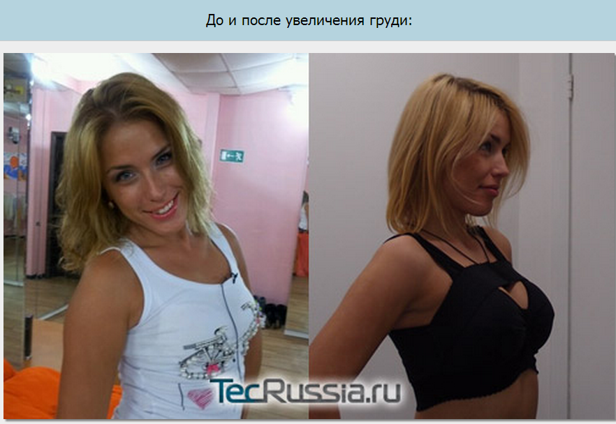 Светлана иванова сделала маммопластику до и после фото