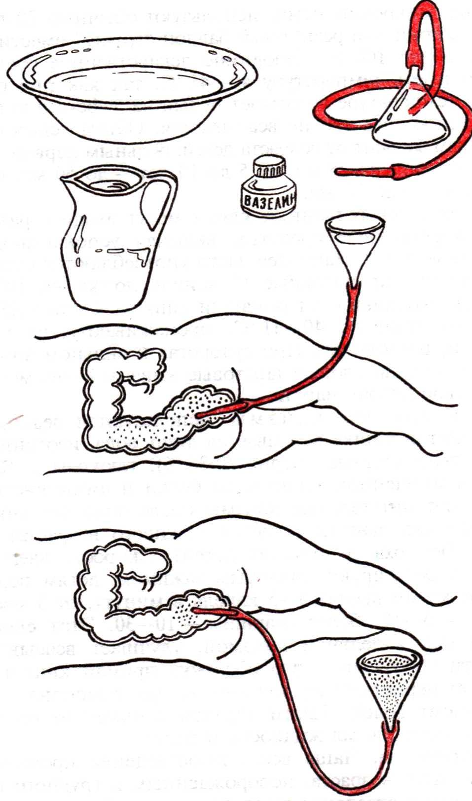 Кишечные клизмы. Клизма чаша Эсмарха. Очистительная клизма Кружка Эсмарха. Промывание кишечника Кружка Эсмарха. Сифонная клизма Кружка.