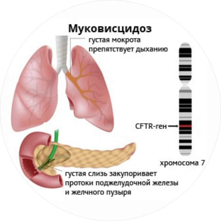 Муковисцидоз педиатрия презентация