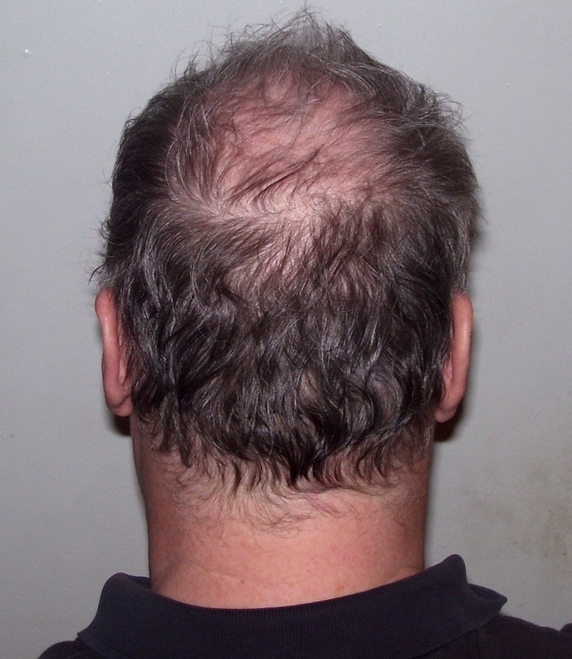 Как остановить выпадение волос при псориазе на голове