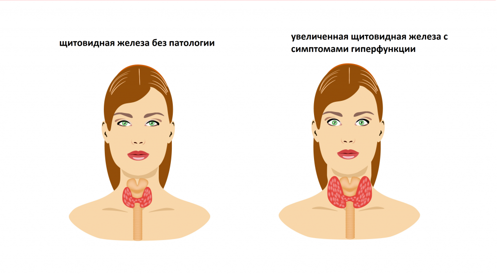 Щитовидная железа симптомы у женщин признаки. Women enlarge pdf.