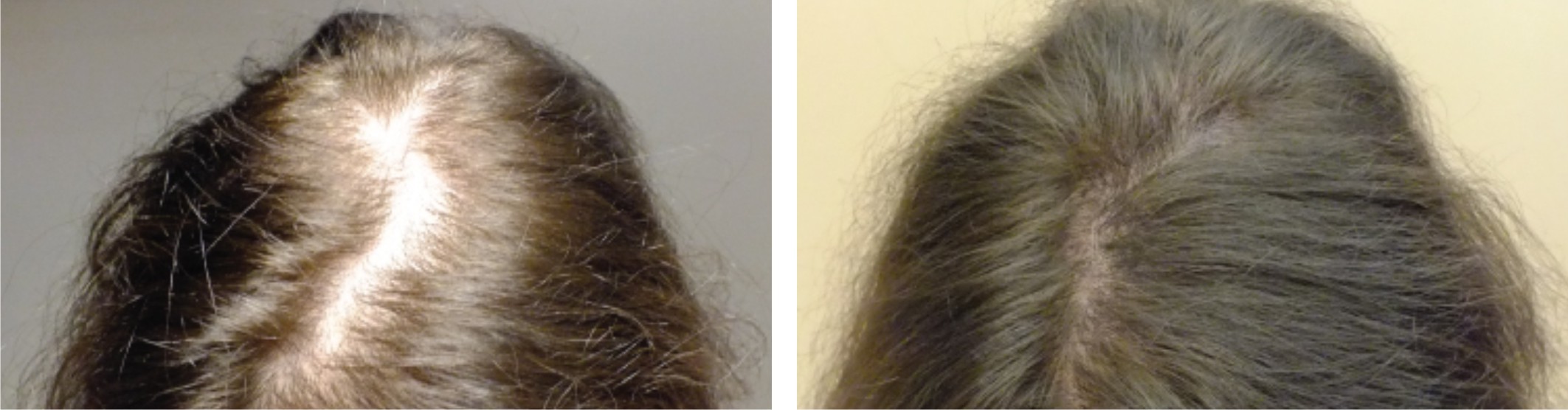 Ковид волосы выпадают что делать. Дарсонваль для волос результат. Волосы до после выпадения волос. Дарсонваль для волос до и после.