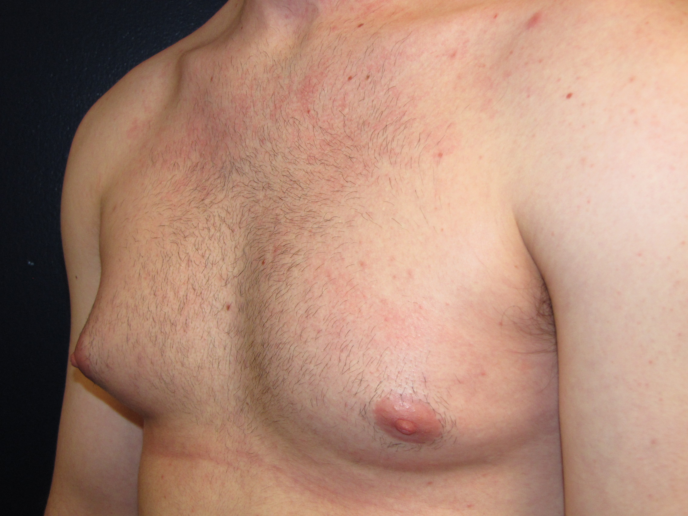красное уплотнение на груди у мужчин (120) фото